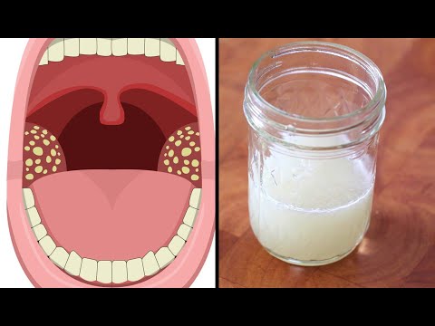 5 remedios efectivos para aliviar las úlceras de la garganta